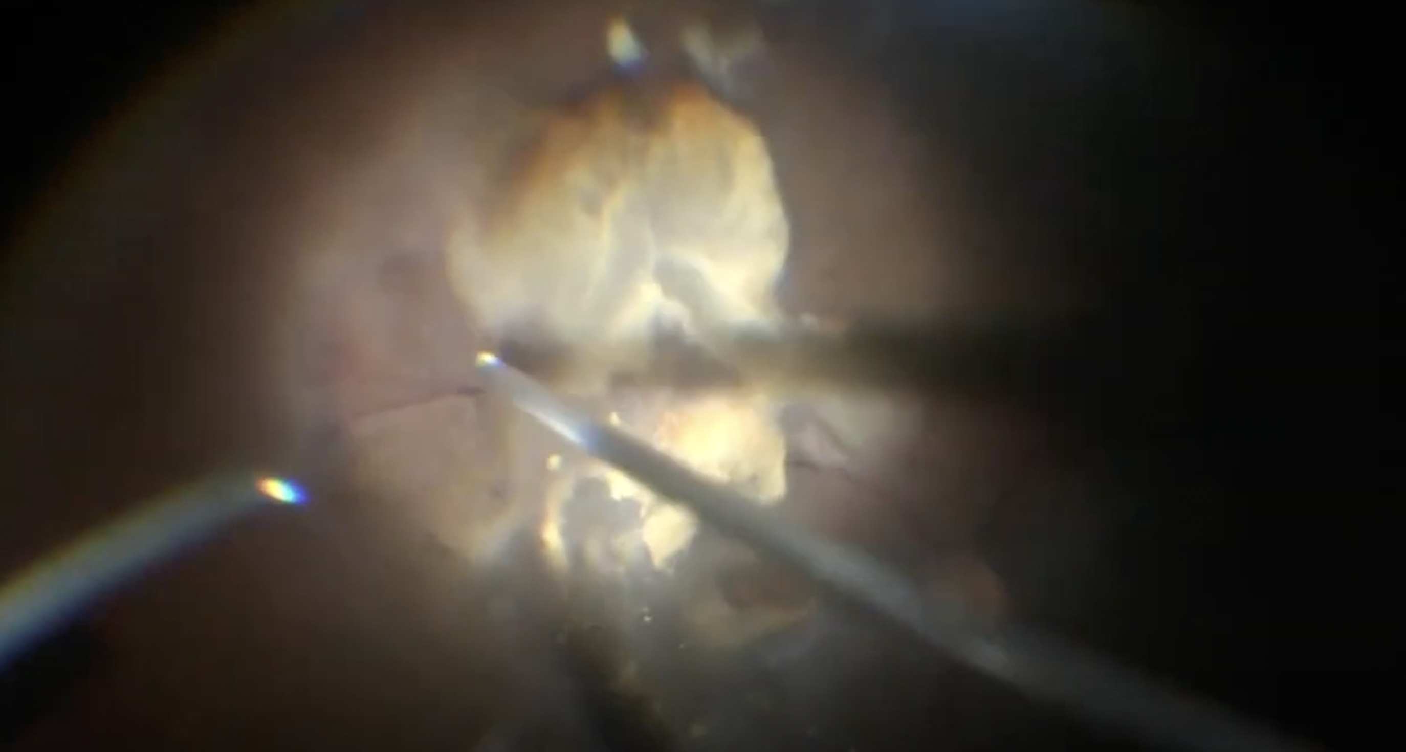 25-Gauge Vitrectomy for Advanced Active Proliferative Diabetic